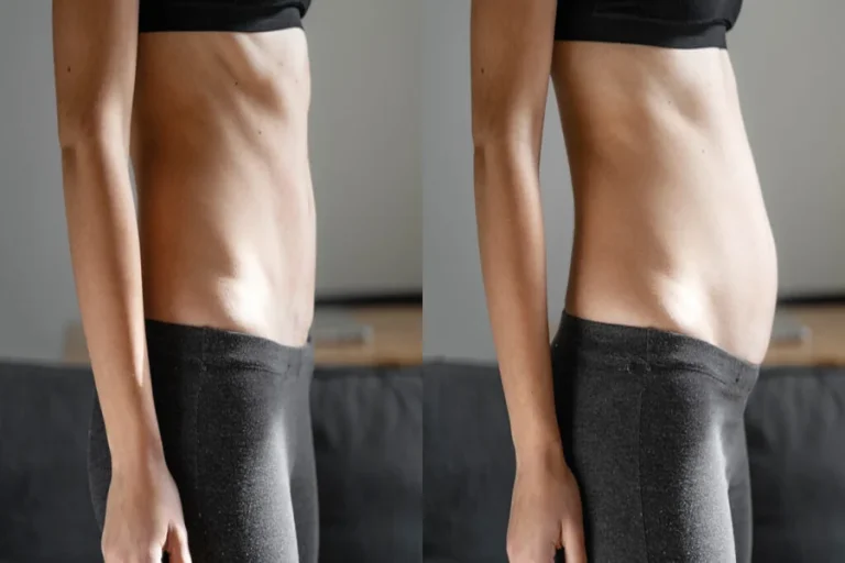 How Long Does It Take To Fix Diastasis Recti Safely