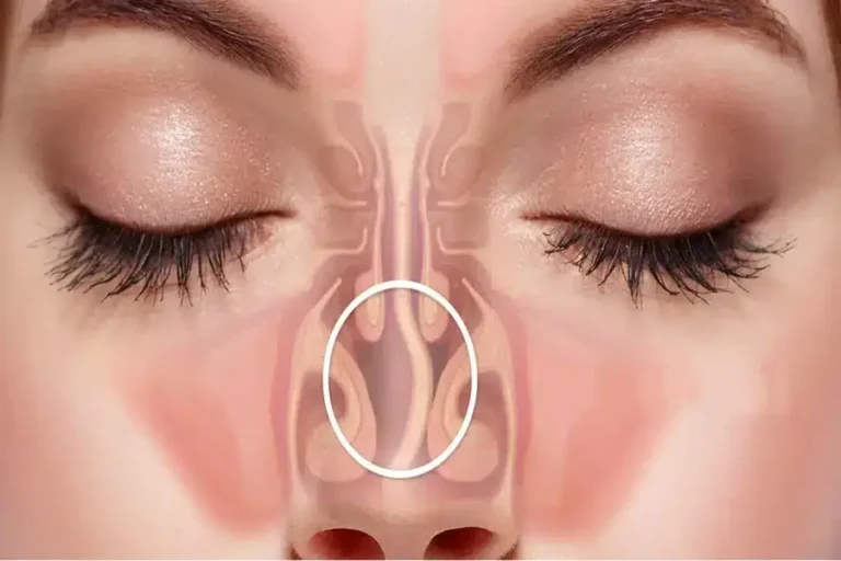 How Much Does It Cost To Fix Deviated Septum
